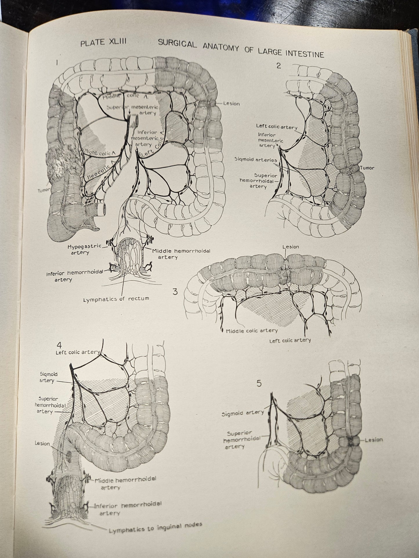 vintage blue ATLAS OF SURGICAL OPPERATIONS medical book