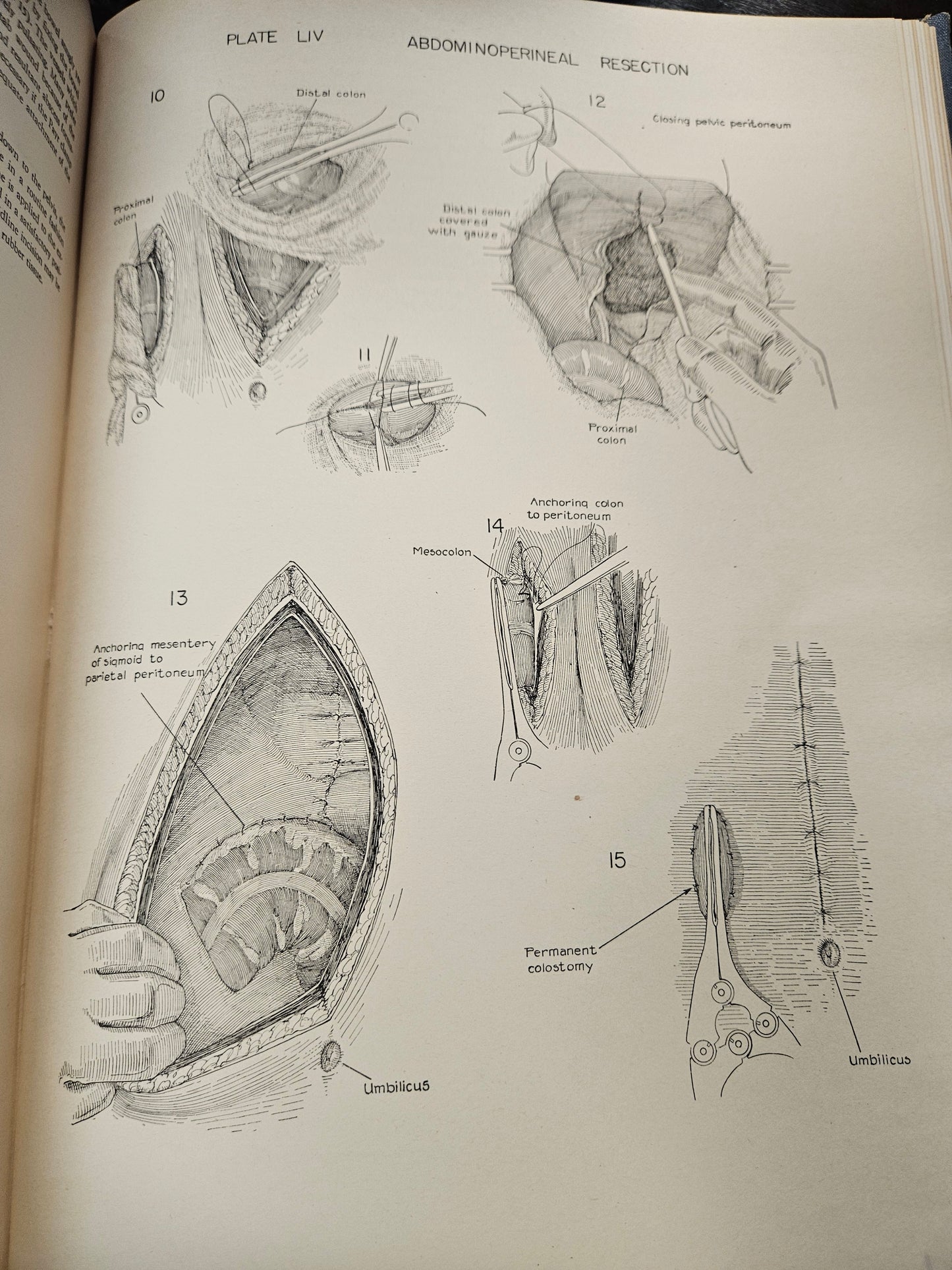 vintage blue ATLAS OF SURGICAL OPPERATIONS medical book